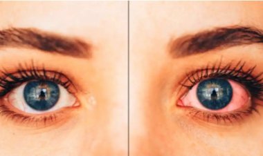 बारिश के मौसम में तेजी से फैल रहा आई फ्लू